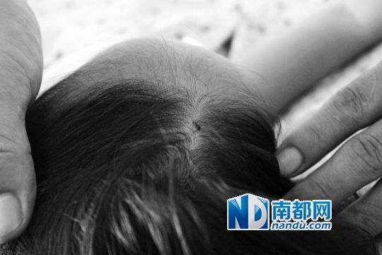 女童頭上被扎的針孔（圓圈處）。賈先生說，被扎不到三秒鐘，女兒就昏了。